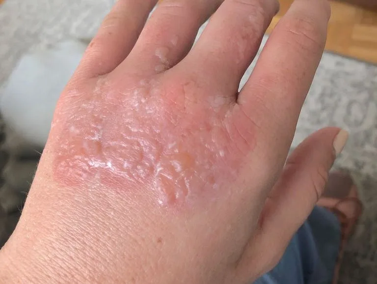 phytophotodermatitis